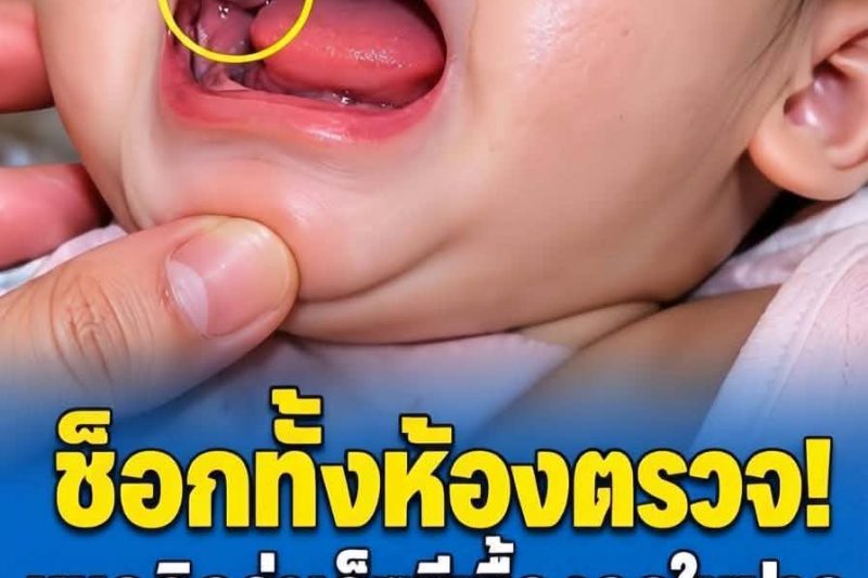 หมอตกใจ คิดว่าทารก 9 เดือน มีเ.นื้.องอ.กในช่องปาก